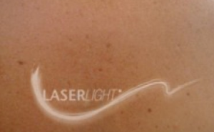 Piel después de pasarl laser tattoo